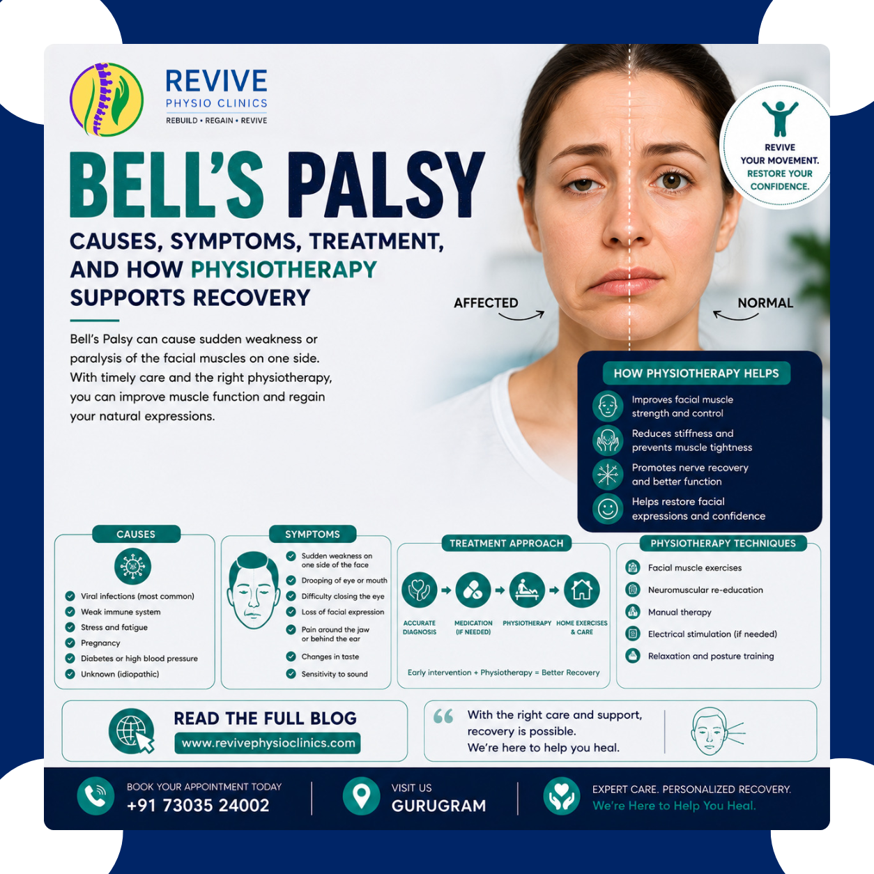 Bell’s Palsy